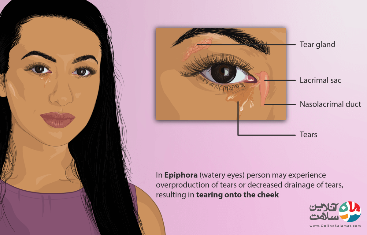 بیماری چشمی اپی فورا