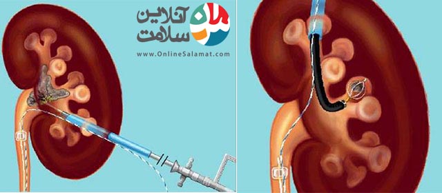 اندازه های سنگ کلیه