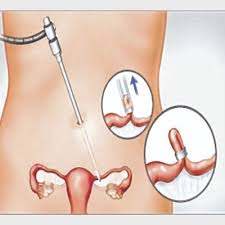 بستن لوله رحم